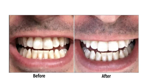 The question “Do whitening strips damage teeth?” depends largely on how they are used.