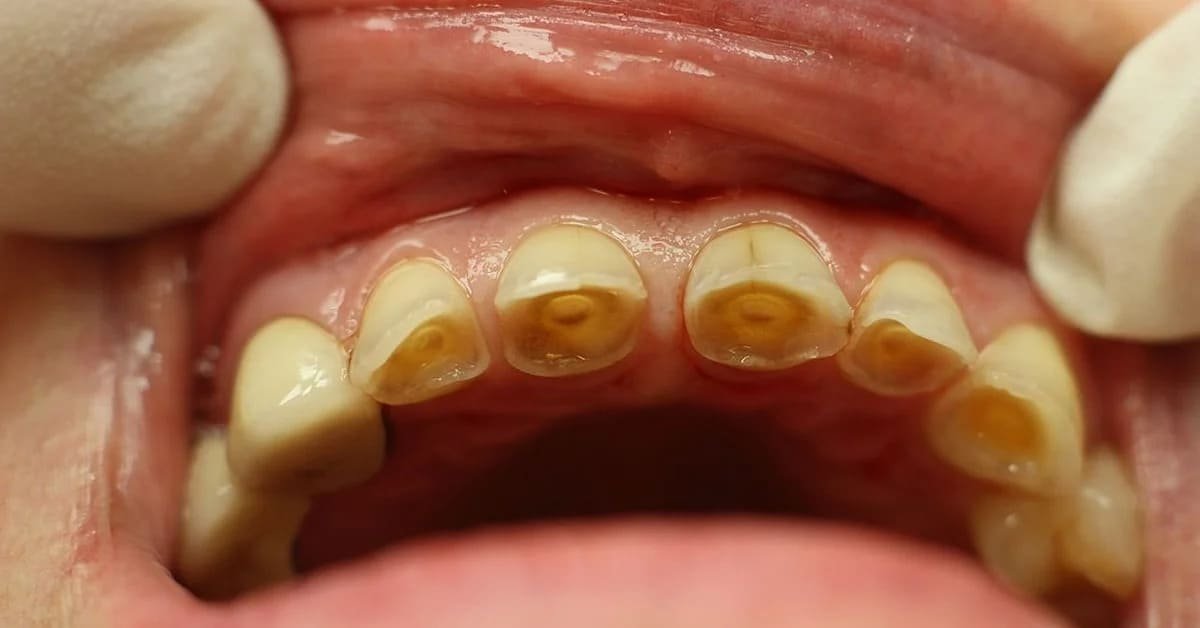 What Causes Tooth Enamel to Wear Down?