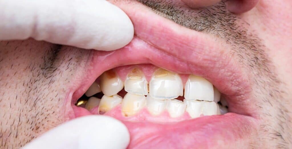 How to Make Tooth Enamel Last Longer