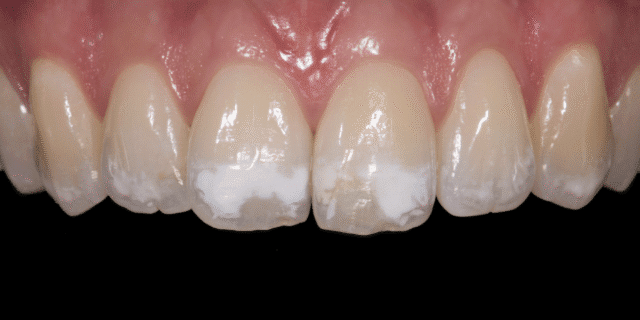 Top 10 Tips to Treat White Spots on Teeth