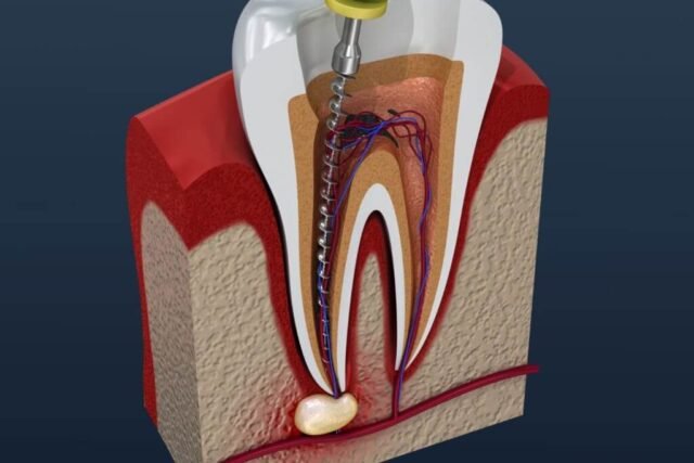 How to Evaluate a Clinic for Root Canal (Don’t Just Compare Price)