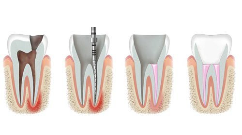 Root Canal Treatment Price in Karachi - Our Studio