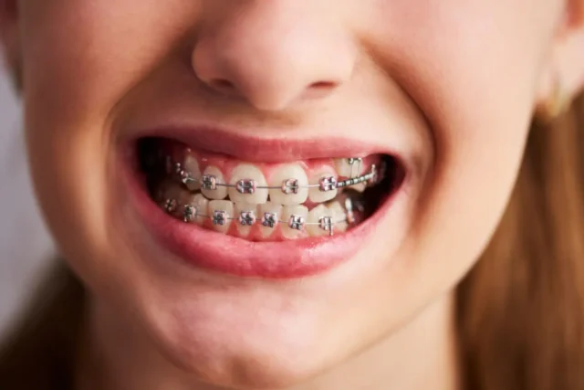 What Affects the Cost of Braces?