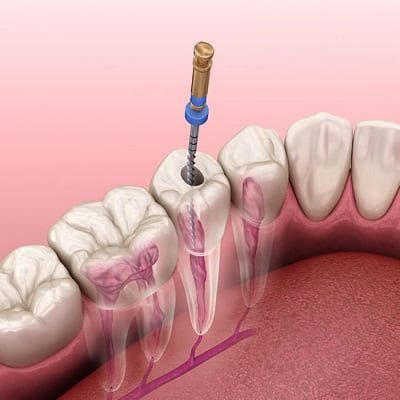 A root canal (endodontic therapy) is a dental procedure to remove infected or damaged pulp (nerve tissue) inside a tooth.