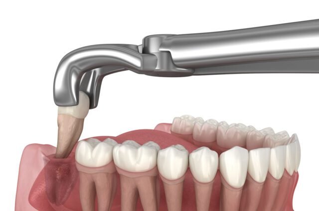 When Is Wisdom Tooth Extraction Required?