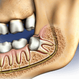 Cost of Wisdom Tooth Extraction