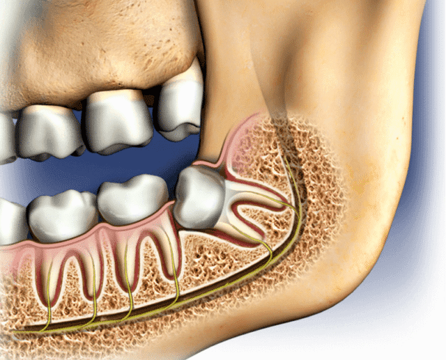 What Are Wisdom Teeth?