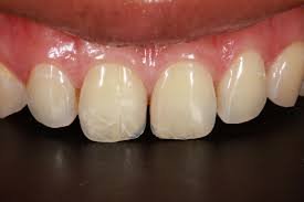 What Can Dentists Do To Minor Cracks in Tooth