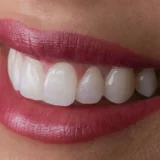 How Much Do Veneers Cost