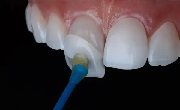 How Much Do Veneers Cost