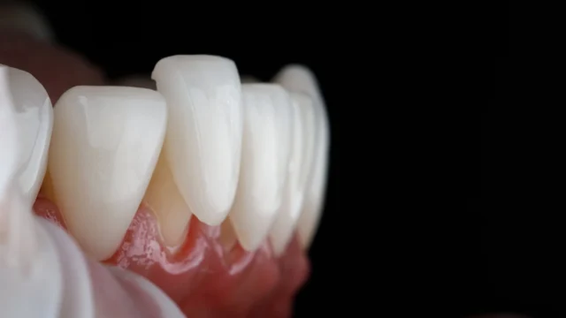 How Much Do Veneers Cost
